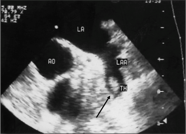 Échographie cardiaque montrant un thrombus (TH) dansl’oreillette gauche chez un patient ayant une fibrillation atriale (trouble du rythme cardiaque favorisant la formation d’un thrombus)