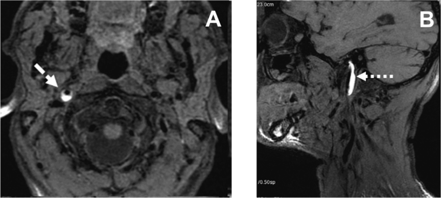 Imagerie par résonance magnétique nucléaire (IRM) montant un hématome (en blanc) dans la paroi de
l’artère carotide interne. A: coupe transversale au niveau du cou. B. coupe sagittale au niveau du cou