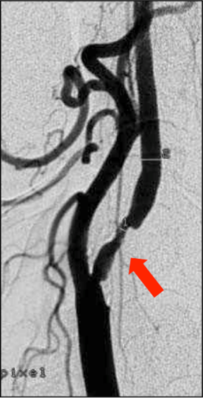 Rétrécissement de l’origine de l’artère carotide interne par une plaque d’athérosclérose (flèche)